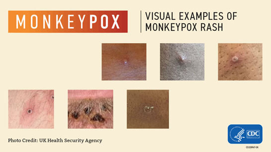 Monkeypox Visual Examples of Monkeypox Rash - Centers for Disease Control